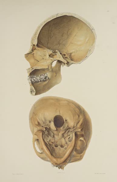 The Necropolis of Ancon Vol. 3 - Greatly deformed Skull [III] (1880)