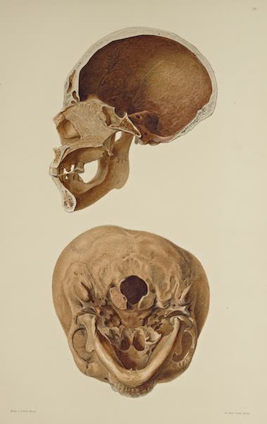 The Necropolis of Ancon Vol. 3 - Greatly deformed Skull [VI] (1880)